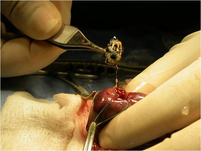 Extraction chirurgicale d’un corps étranger intestinal