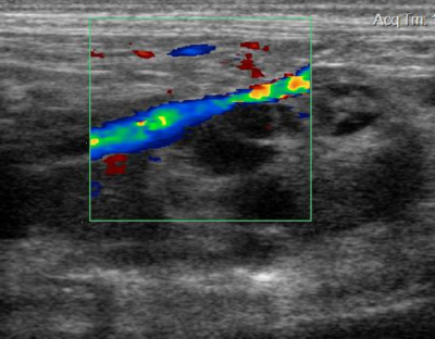 Compression of the vena cava by the right adrenal gland. Photo credit: Dr. Sue Chen