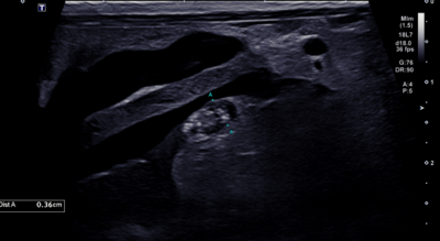 Mineralization of the right adrenal gland. Photo credit: Dr. Sue Chen