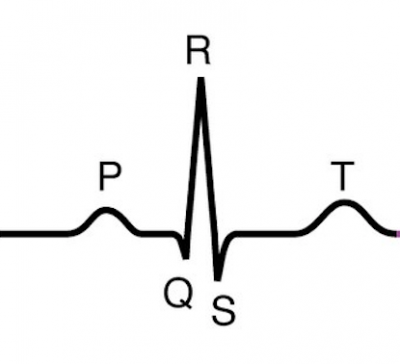 The classic ECG tracing consists of a P wave (atrial depolarization), QRS wave (ventricular depolarization), and T wave (ventricular repolarization)