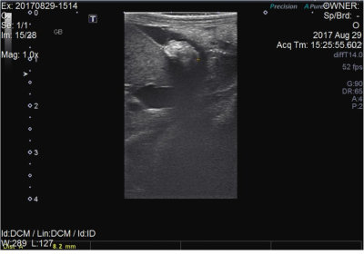 Ultrasonographic image of the liver, distended gallbladder, and common bile duct in a guinea pigas well as an 8.2 mm cholelith (between “+” symbols) within the common bile duct