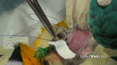 Secure the catheter with a butterfly strip of tape and suture