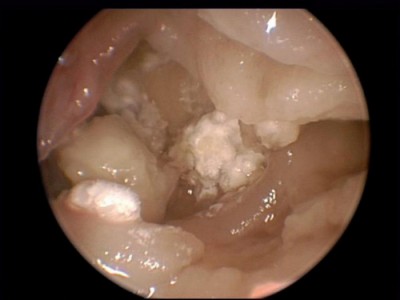 aspergilloma Divers