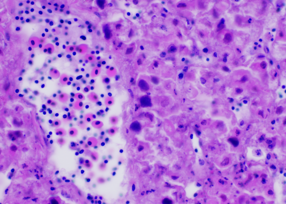 Adenoviral infection in a juvenile inland bearded dragon with prominent basophilic intranuclear viral inclusions within hepatocytes.
