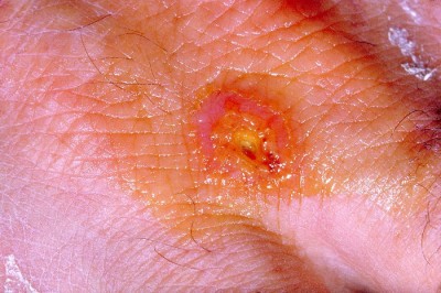 skin ulcer tularemia 