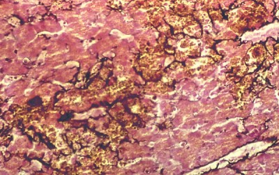 Histology of a liver with iron storage disease