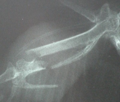 Metacarpal fracture