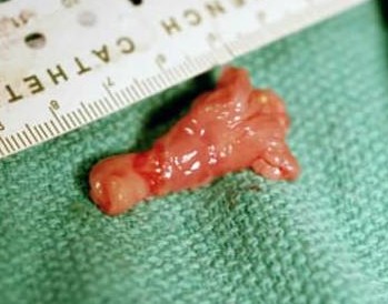 Helicobacter mustelae may overgrow leading to pyloric ulcers